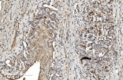 IHC staining of FFPE human gastric cancer tissue with COL4A3 antibody. HIER: boil tissue sections in pH8 EDTA for 20 min and allow to cool before testing.