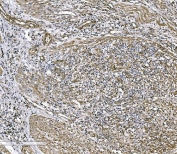 IHC staining of FFPE human rectal cancer tissue with COL4A3 antibody. HIER: boil tissue sections in pH8 EDTA for 20 min and allow to cool before testing.