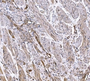 IHC staining of FFPE human renal cancer tissue with COL4A3 antibody. HIER: boil tissue sections in pH8 EDTA for 20 min and allow to cool before testing.