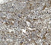 IHC staining of FFPE human liver cancer tissue with COL4A3 antibody. HIER: boil tissue sections in pH8 EDTA for 20 min and allow to cool before testing.