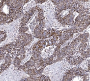 IHC staining of FFPE human liver cancer tissue with COX6B1 antibody. HIER: boil tissue sections in pH8 EDTA for 20 min and allow to cool before testing.