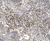 IHC staining of FFPE human lung cancer tissue with DAP-1 antibody. HIER: boil tissue sections in pH8 EDTA for 20 min and allow to cool before testing.