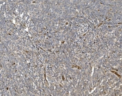 IHC staining of FFPE human lymphoma tissue with EIF3C antibody. HIER: boil tissue sections in pH8 EDTA for 20 min and allow to cool before testing.