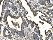 IHC staining of FFPE human pancreatic cancer tissue with KIF2A antibody. HIER: boil tissue sections in pH8 EDTA for 20 min and allow to cool before testing.