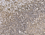IHC staining of FFPE human lung cancer tissue with KIF2A antibody. HIER: boil tissue sections in pH8 EDTA for 20 min and allow to cool before testing.