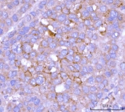 IHC staining of FFPE human liver cancer tissue with TRNT1 antibody. HIER: boil tissue sections in pH8 EDTA for 20 min and allow to cool before testing.