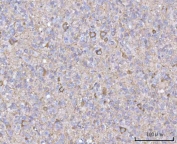 IHC staining of FFPE human glioblastoma tissue with NECAB1 antibody. HIER: boil tissue sections in pH8 EDTA for 20 min and allow to cool before testing.