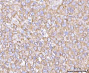 IHC staining of FFPE human liver cancer tissue with NANP antibody. HIER: boil tissue sections in pH8 EDTA for 20 min and allow to cool before testing.