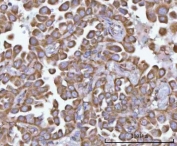 IHC staining of FFPE human lung adenocarcinoma tissue with NANP antibody. HIER: boil tissue sections in pH8 EDTA for 20 min and allow to cool before testing.