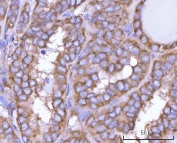 IHC staining of FFPE human thyroid papillary carcinoma tissue with NANP antibody. HIER: boil tissue sections in pH8 EDTA for 20 min and allow to cool before testing.