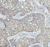 IHC staining of FFPE human lung cancer tissue with Clathrin heavy chain antibody. HIER: boil tissue sections in pH8 EDTA for 20 min and allow to cool before testing.