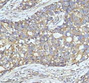 IHC staining of FFPE human lung cancer tissue with Clathrin heavy chain antibody. HIER: boil tissue sections in pH8 EDTA for 20 min and allow to cool before testing.