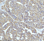 IHC staining of FFPE human liver cancer tissue with Clathrin heavy chain antibody. HIER: boil tissue sections in pH8 EDTA for 20 min and allow to cool before testing.