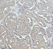 IHC staining of FFPE human liver cancer tissue with Clathrin heavy chain antibody. HIER: boil tissue sections in pH8 EDTA for 20 min and allow to cool before testing.