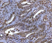 IHC staining of FFPE human colorectal adenocarcinoma tissue with NR5A2 antibody. HIER: boil tissue sections in pH8 EDTA for 20 min and allow to cool before testing.