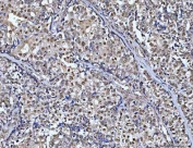 IHC staining of FFPE human ovarian cancer tissue with CHD8 antibody. HIER: boil tissue sections in pH8 EDTA for 20 min and allow to cool before testing.