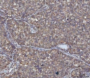 IHC staining of FFPE human non-small cell lung cancer tissue with Acetyl-CoA acetyltransferase antibody. HIER: boil tissue sections in pH8 EDTA for 20 min and allow to cool before testing.