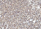 IHC staining of FFPE human acinar adenocarcinoma of prostate tissue with NUMA1 antibody. HIER: boil tissue sections in pH8 EDTA for 20 min and allow to cool before testing.