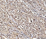 IHC staining of FFPE human esophageal squamous carcinoma tissue with NUMA1 antibody. HIER: boil tissue sections in pH8 EDTA for 20 min and allow to cool before testing.