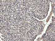 IHC staining of FFPE human breast cancer tissue with NUMA1 antibody. HIER: boil tissue sections in pH8 EDTA for 20 min and allow to cool before testing.