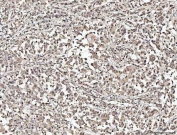 IHC staining of FFPE human lung cancer tissue with NUMA1 antibody. HIER: boil tissue sections in pH8 EDTA for 20 min and allow to cool before testing.