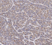 IHC staining of FFPE human liver cancer tissue with MAD2B antibody. HIER: boil tissue sections in pH8 EDTA for 20 min and allow to cool before testing.