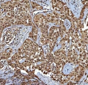 IHC staining of FFPE human acinic cell carcinoma of the parotid gland tissue with TR4 antibody. HIER: boil tissue sections in pH8 EDTA for 20 min and allow to cool before testing.