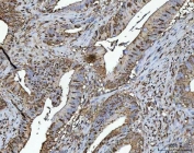 IHC staining of FFPE human colorectal adenocarcinoma tissue with TR4 antibody. HIER: boil tissue sections in pH8 EDTA for 20 min and allow to cool before testing.