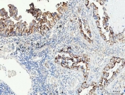 IHC staining of FFPE human lung adenocarcinoma tissue with Proline dehydrogenase 1 antibody. HIER: boil tissue sections in pH8 EDTA for 20 min and allow to cool before testing.