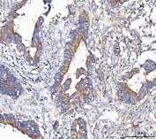 IHC staining of FFPE human colorectal adenocarcinoma tissue with METAP2 antibody. HIER: boil tissue sections in pH8 EDTA for 20 min and allow to cool before testing.