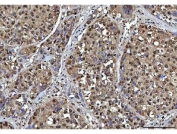 IHC staining of FFPE human liver cancer tissue with NSUN2 antibody. HIER: boil tissue sections in pH8 EDTA for 20 min and allow to cool before testing.