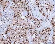 IHC staining of FFPE human acinic cell carcinoma tissue with NSUN2 antibody. HIER: boil tissue sections in pH8 EDTA for 20 min and allow to cool before testing.