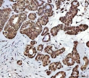 IHC staining of FFPE human ovarian cancer tissue with NSUN2 antibody. HIER: boil tissue sections in pH8 EDTA for 20 min and allow to cool before testing.