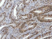 IHC staining of FFPE human colorectal adenocarcinoma tissue with NSUN2 antibody. HIER: boil tissue sections in pH8 EDTA for 20 min and allow to cool before testing.