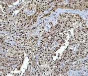 IHC staining of FFPE human urothelial carcinoma tissue with NSUN2 antibody. HIER: boil tissue sections in pH8 EDTA for 20 min and allow to cool before testing.