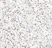 IHC staining of FFPE human liver cancer tissue with NUCKS1 antibody. HIER: boil tissue sections in pH8 EDTA for 20 min and allow to cool before testing.