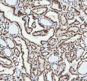 IHC staining of FFPE human thyroid papillary carcinoma tissue with NUCKS1 antibody. HIER: boil tissue sections in pH8 EDTA for 20 min and allow to cool before testing.
