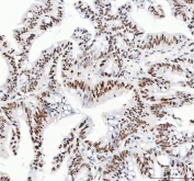 IHC staining of FFPE human rectum adenocarcinoma tissue with NUCKS1 antibody. HIER: boil tissue sections in pH8 EDTA for 20 min and allow to cool before testing.