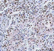 IHC staining of FFPE human lung cancer tissue with NUCKS1 antibody. HIER: boil tissue sections in pH8 EDTA for 20 min and allow to cool before testing.