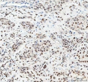 IHC staining of FFPE human esophageal squamous carcinoma tissue with NUCKS1 antibody. HIER: boil tissue sections in pH8 EDTA for 20 min and allow to cool before testing.