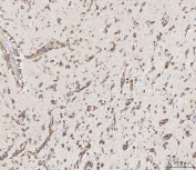 IHC staining of FFPE human glioma tissue with MMP19 antibody. HIER: boil tissue sections in pH8 EDTA for 20 min and allow to cool before testing.