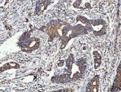 IHC staining of FFPE human colorectal adenocarcinoma tissue with MMP19 antibody. HIER: boil tissue sections in pH8 EDTA for 20 min and allow to cool before testing.