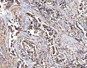 IHC staining of FFPE human lung cancer tissue with MARK3 antibody. HIER: boil tissue sections in pH8 EDTA for 20 min and allow to cool before testing.