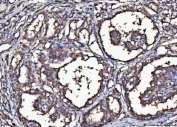 IHC staining of FFPE human thyroid cancer tissue with MARK3 antibody. HIER: boil tissue sections in pH8 EDTA for 20 min and allow to cool before testing.