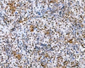 IHC staining of FFPE human testicular germ cell tumor tissue with NVL antibody. HIER: boil tissue sections in pH8 EDTA for 20 min and allow to cool before testing.