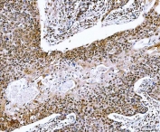 IHC staining of FFPE human esophageal squamous carcinoma tissue with NVL antibody. HIER: boil tissue sections in pH8 EDTA for 20 min and allow to cool before testing.