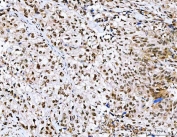 IHC staining of FFPE human urothelial carcinoma tissue with NVL antibody. HIER: boil tissue sections in pH8 EDTA for 20 min and allow to cool before testing.