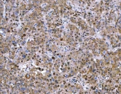 IHC staining of FFPE human liver cancer tissue with NVL antibody. HIER: boil tissue sections in pH8 EDTA for 20 min and allow to cool before testing.