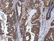 IHC staining of FFPE human colorectal adenocarcinoma tissue with NVL antibody. HIER: boil tissue sections in pH8 EDTA for 20 min and allow to cool before testing.