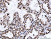 IHC staining of FFPE human lung adenocarcinoma tissue with NVL antibody. HIER: boil tissue sections in pH8 EDTA for 20 min and allow to cool before testing.
